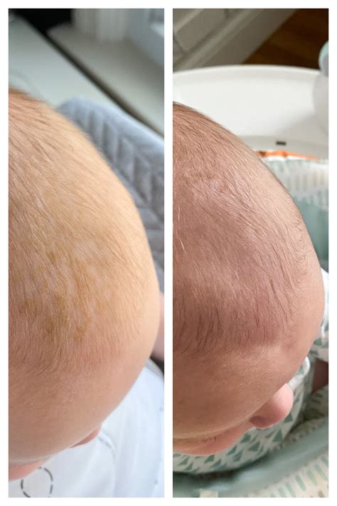 How To Get Rid of Cradle Cap at Home .